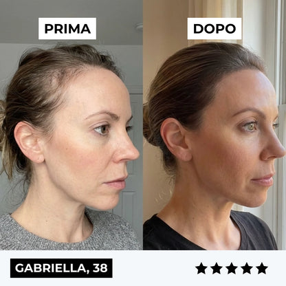 CURENSE - Sistema di micro-infusione per la ricrescita dei capelli