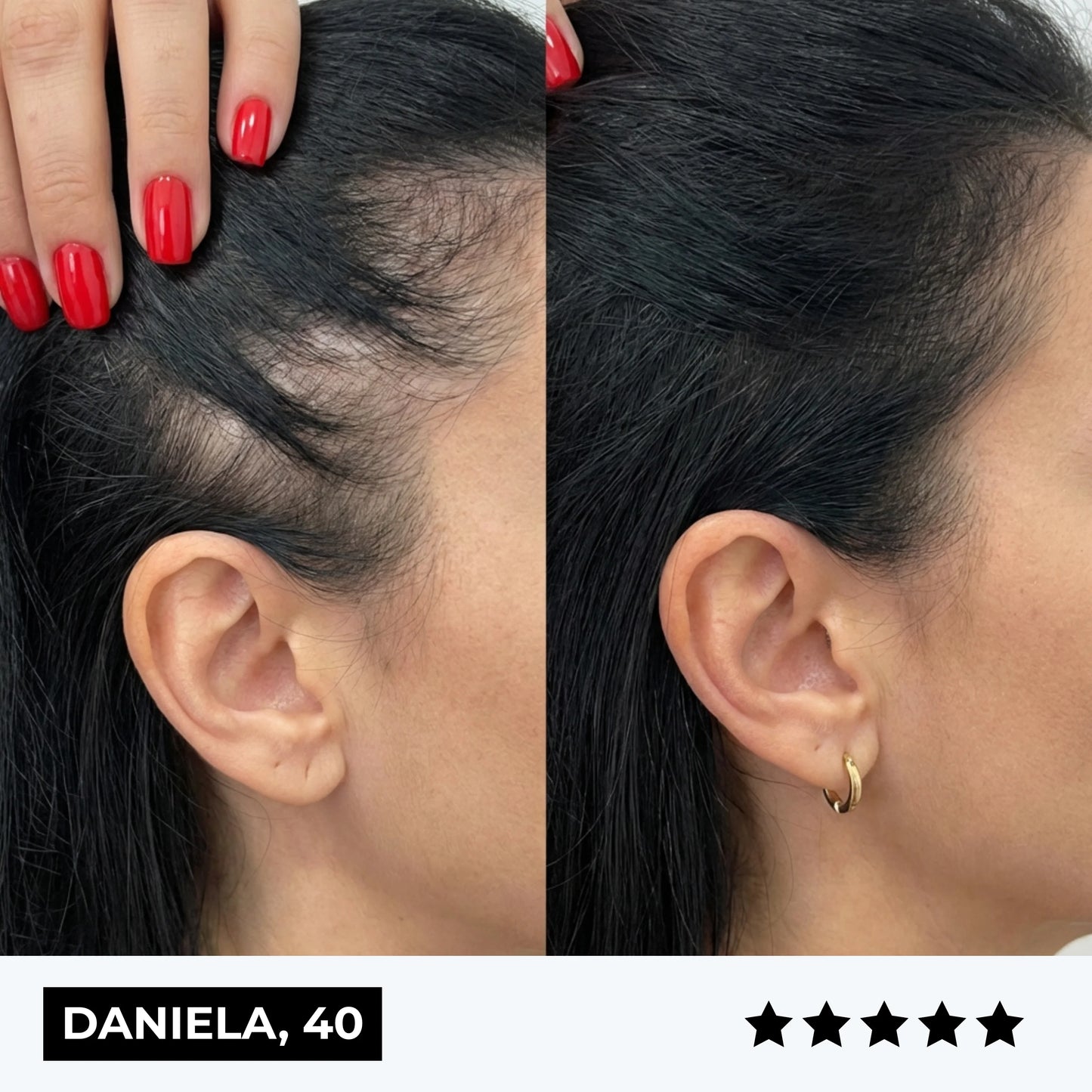 CURENSE - Sistema di micro-infusione per la ricrescita dei capelli