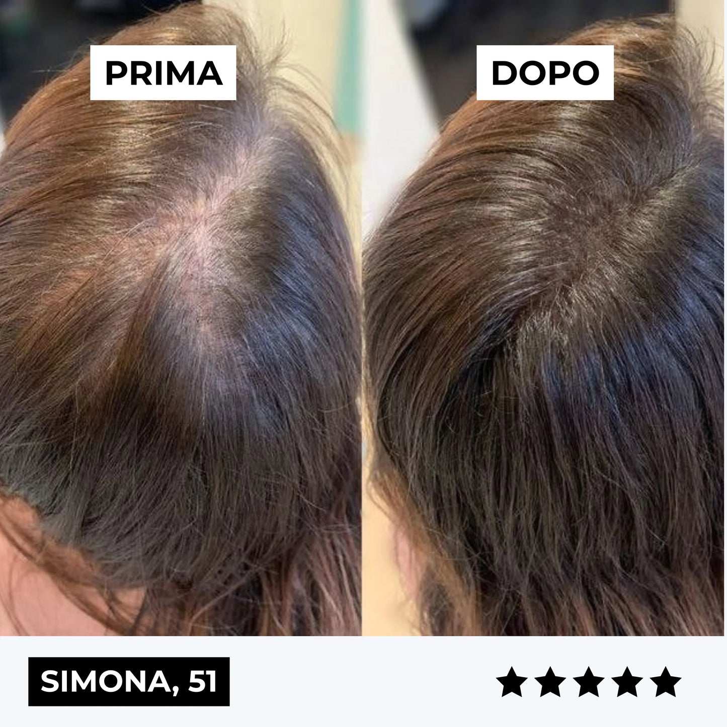 CURENSE - Sistema di micro-infusione per la ricrescita dei capelli