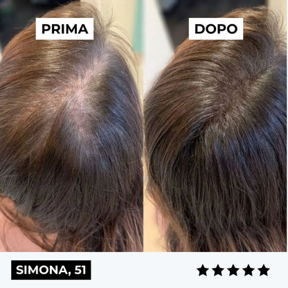 CURENSE - Sistema di micro-infusione per la ricrescita dei capelli