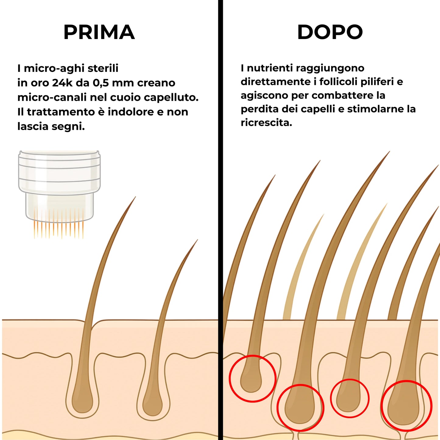 CURENSE - Sistema di micro-infusione per la ricrescita dei capelli
