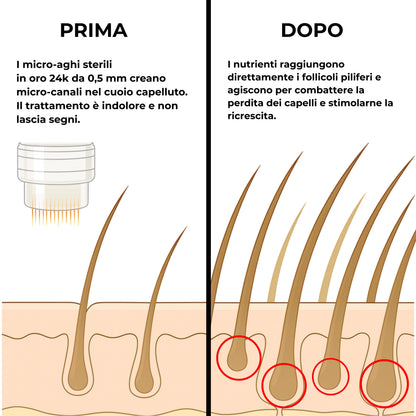 CURENSE - Sistema di micro-infusione per la ricrescita dei capelli